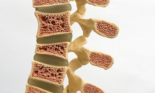 Osteoporoza jest jedną z przyczyn bólu krzyża