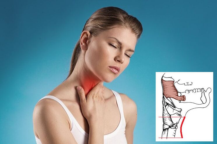 Ból gardła z osteochondrozą szyjną z powodu ucisku nerwu