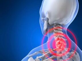 Osteochondroza odcinka szyjnego kręgosłupa
