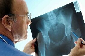 Artroza stawu biodrowego na X -Ray