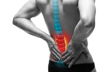 Osteochondroza to choroba kręgosłupa