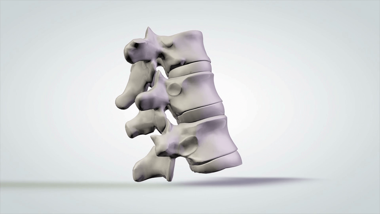 uszkodzenie kręgosłupa z powodu osteochondrozy szyjnej