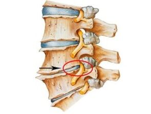 oznaki i objawy osteochondrozy